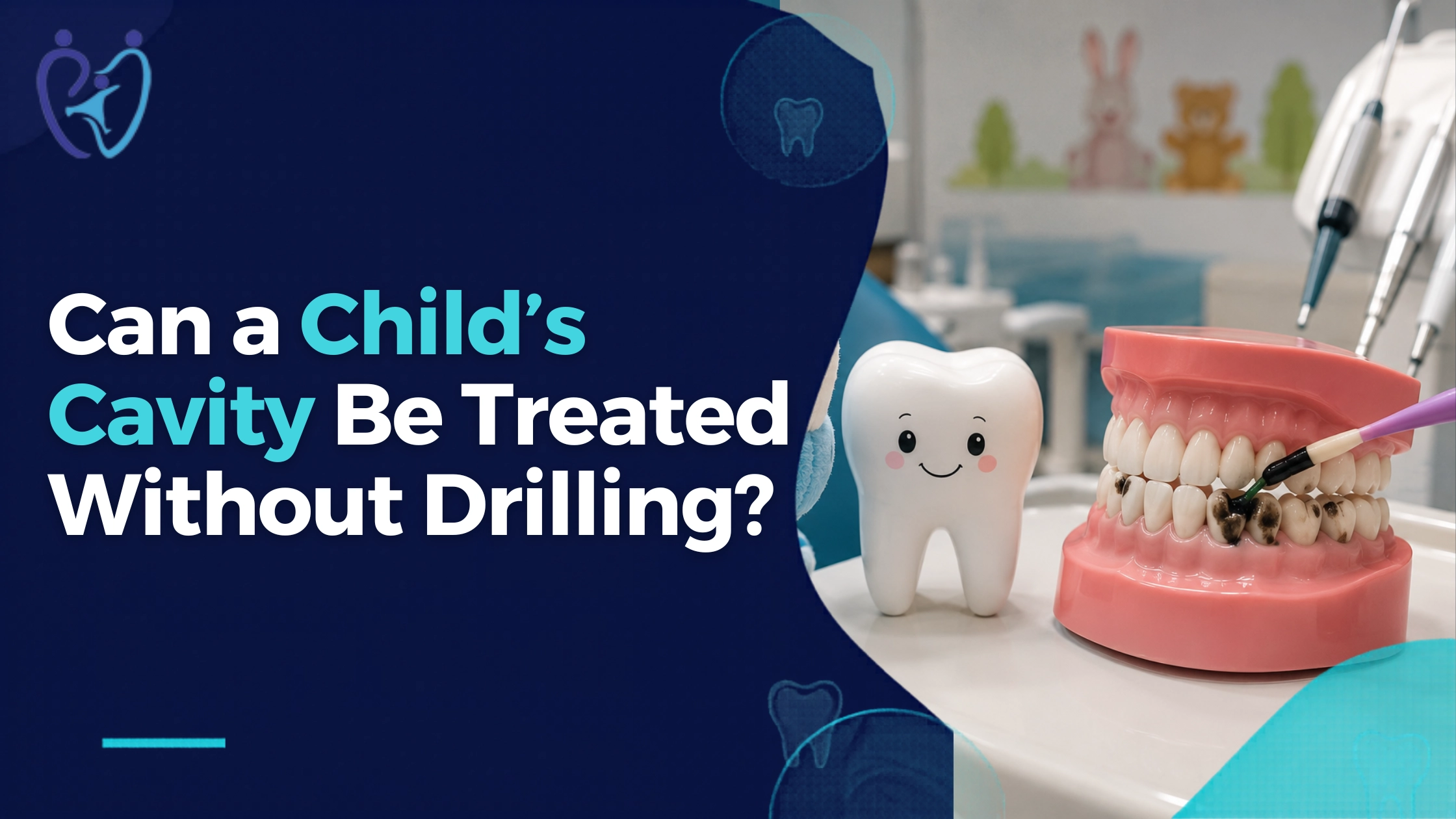 Can a Child’s Cavity Be Treated Without Drilling? A Parents Guide to SDF Treatment