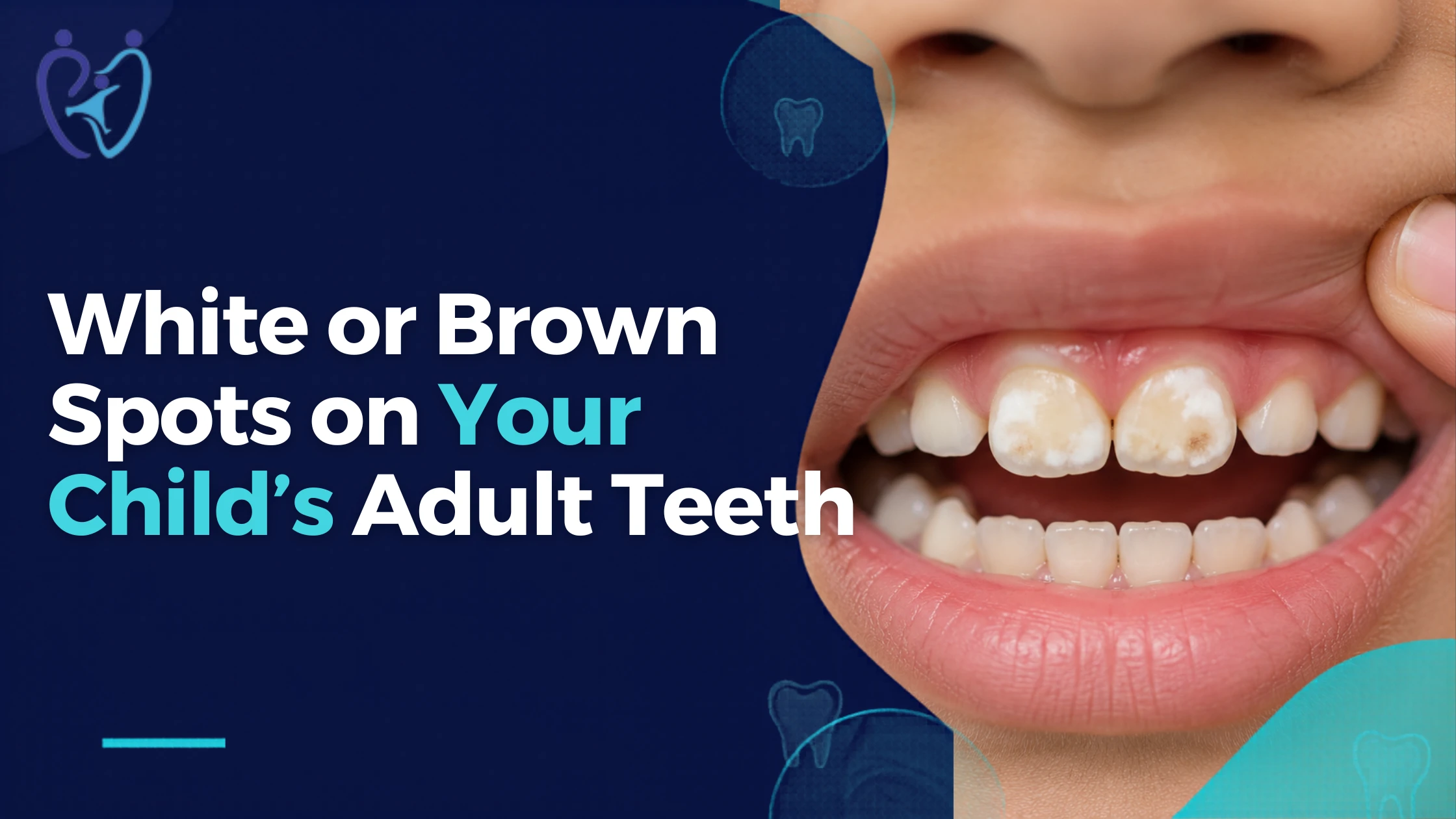 White Or Brown Spots On Your Childs New Adult Teeth? Heres What They Could Mean