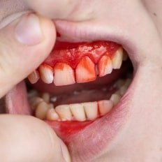 Gum Disease (Gingivitis and Periodontitis)