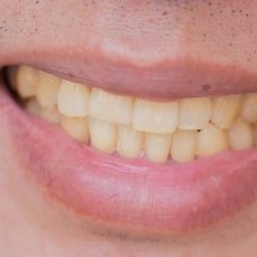 Teeth Discoloration and Stains