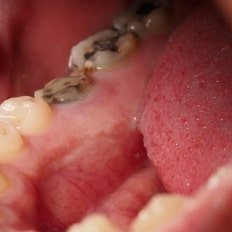 Tooth Decay (Cavities)